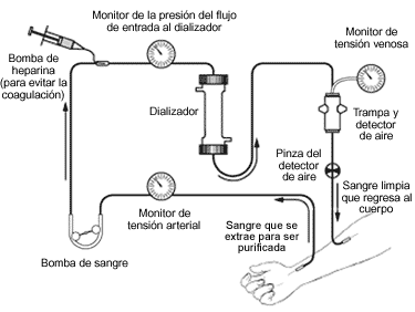 Ilustración de un dializador.