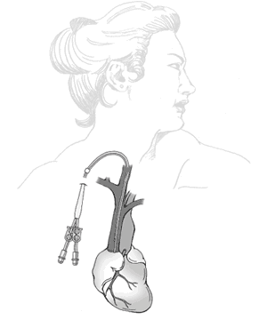 Ilustración de un catéter insertado en el cuello .