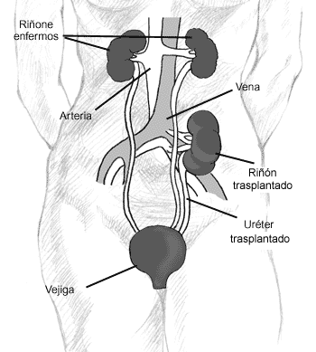 Ilustración de una transplante del riñón.